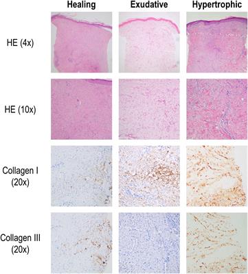 In-stent restenosis is associated with proliferative skin healing and specific immune and endothelial cell profiles: results from the RACHEL trial